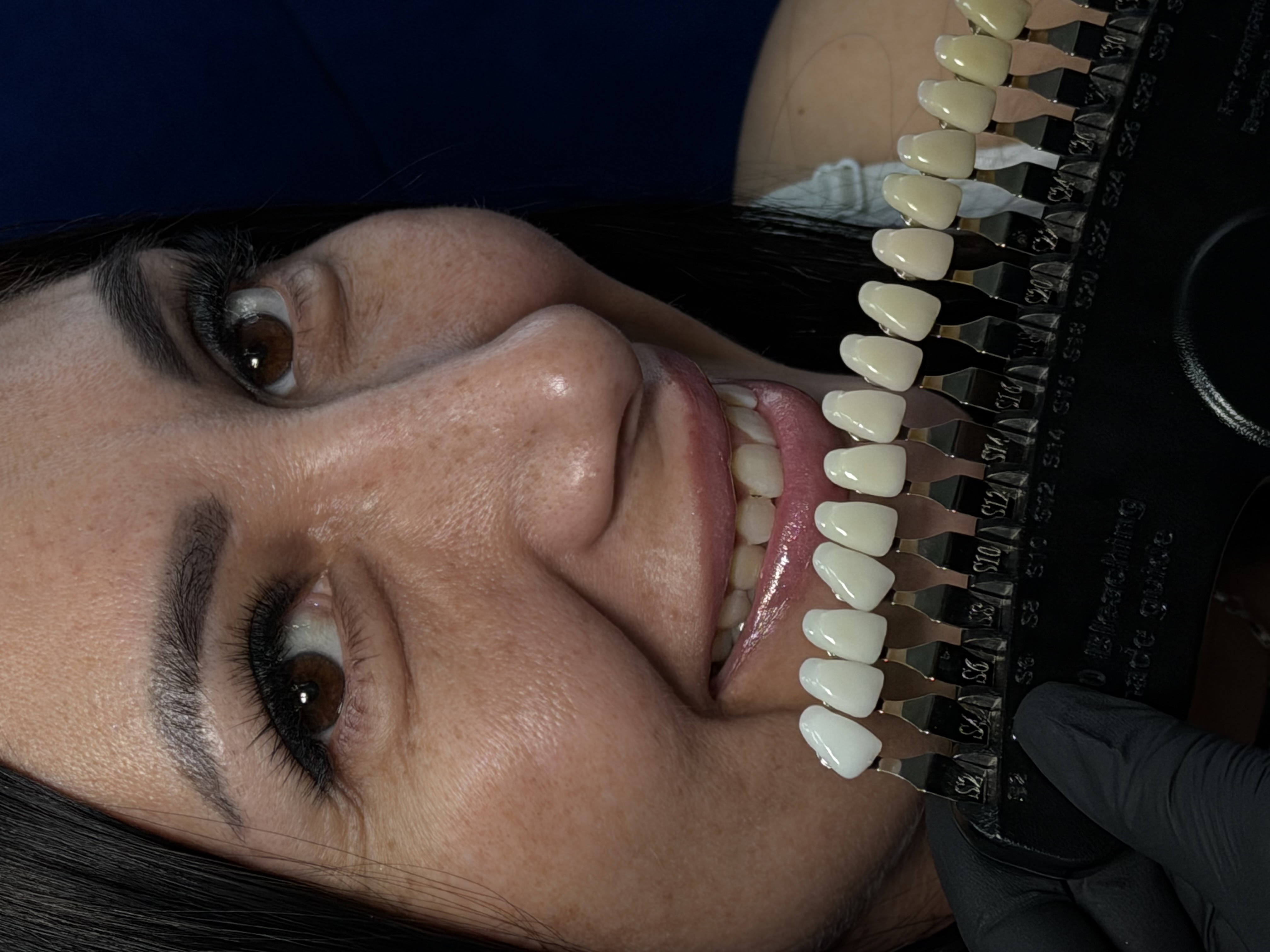 Результат отбеливания